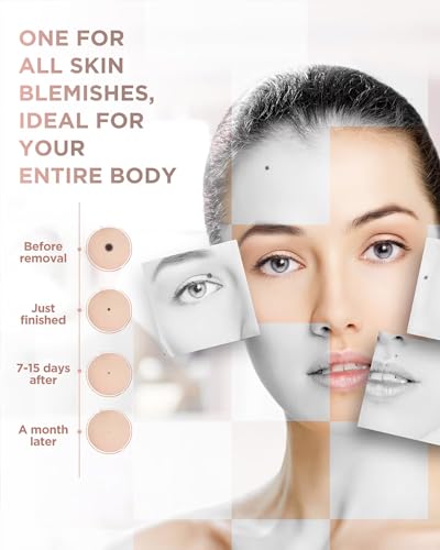 OPHERA Skin Tag Remover Pen with Remover Kits for Moles and Warts, Home Use
