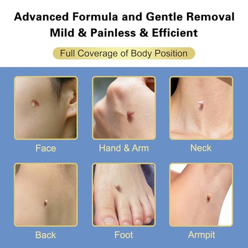 Fast-Acting Skin Tag Remover with Salicylic Acid, With a Precision Brush, Natural & Advanced Formula, Mild & non irritating, Suitable for All Skin Types,Efficiently & Painless Remover Tags, 30ml